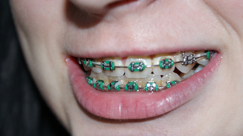 smiling woman with braces